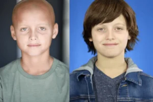 Children With Hair Loss